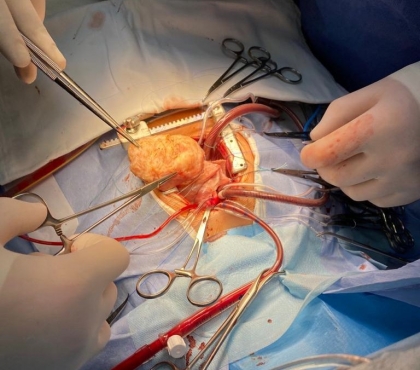 Уникальная операция челябинских хирургов: шестимесячной малютке удалили огромную опухоль на сердце