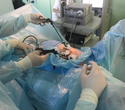 В Челябинске врачи провели уникальную операцию, чтобы достать огромный «коралл» из сдвоенной почки