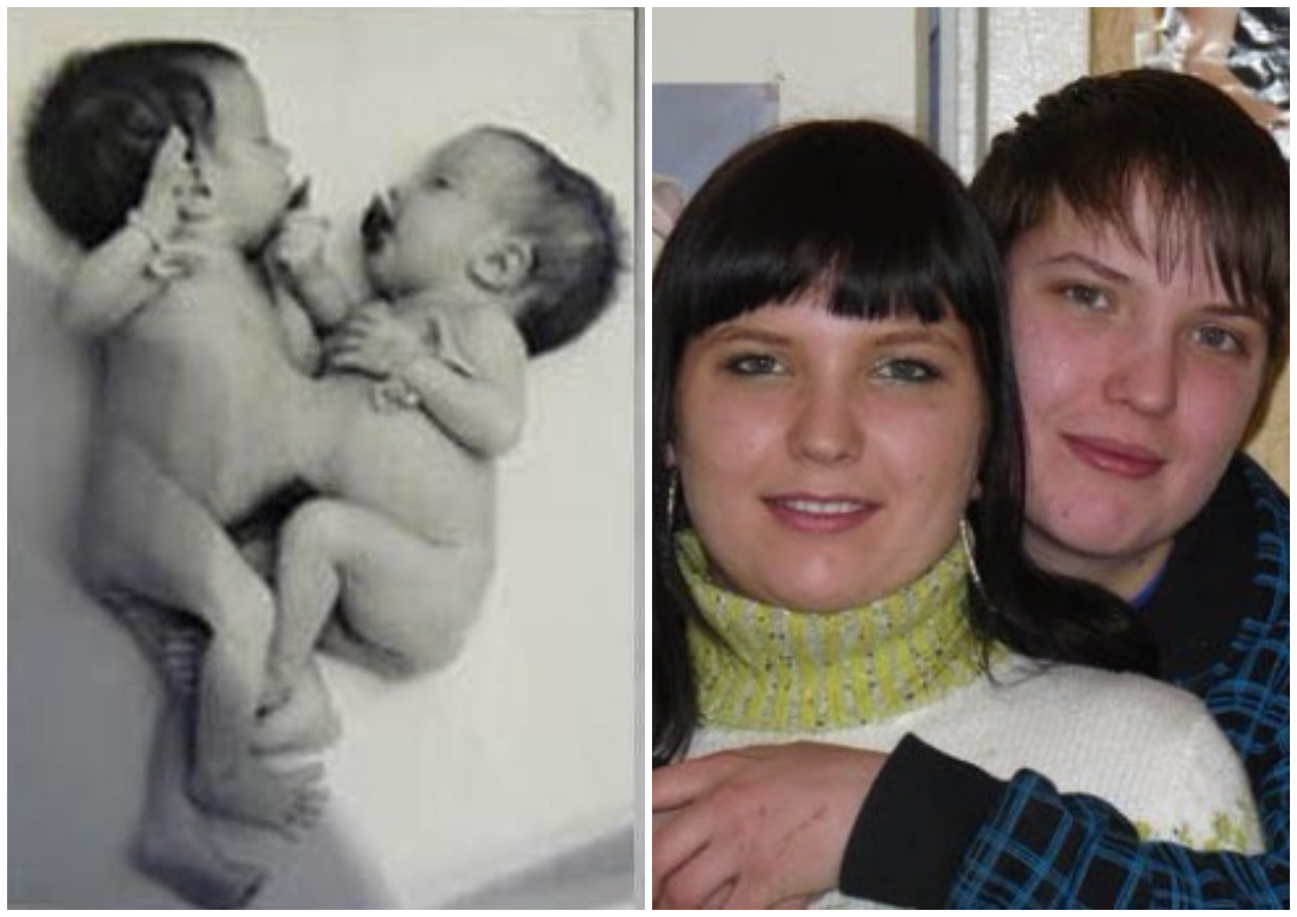 Аня и Таня при рождении и во взрослом возрасте