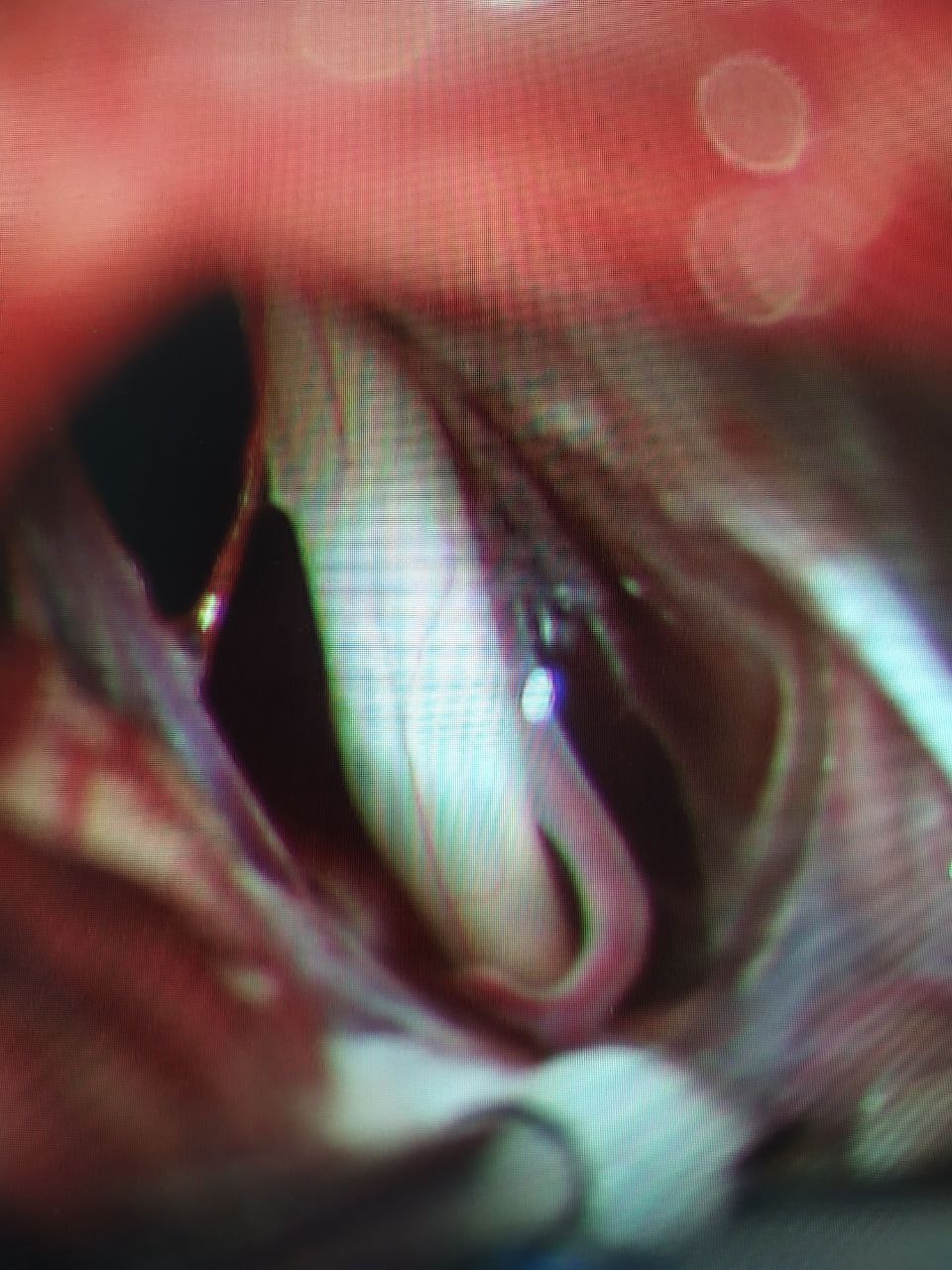 Белое - нерв, красное - артерия. Снимок сделан во время операции через микроскоп с 25-кратным (!) увеличением.