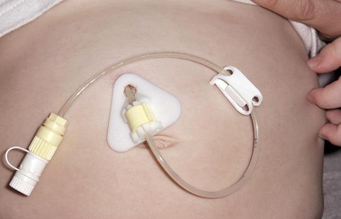 В первый год жизни ребенок был вынужден питаться через трубочку